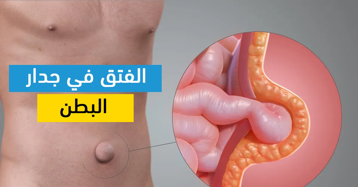 الفتق في جدار البطن